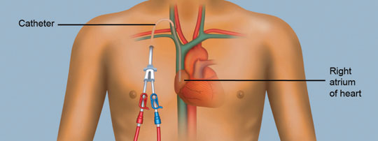 Hermodialysis catheter