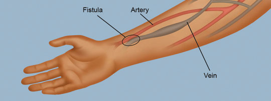 Arteriovenous fistula