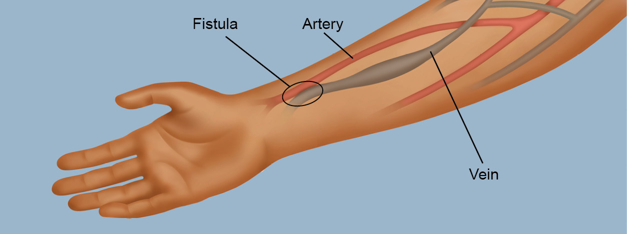Illustration of an AV fistula hemodialysis access placement. The fistula connects an artery to a vein.