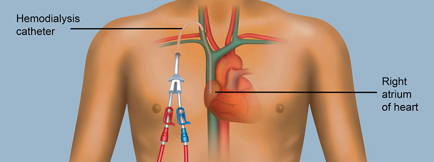 Illustration of a hemiodialysis catheter in a chest: the catheter is connected to a vein that connects to the right atrium of the heart.