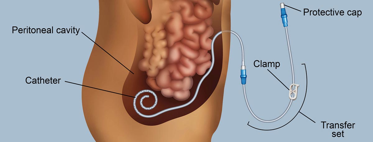 Illustrtion of a peritoneal dialysis catheter. The catheter is placed in the peritoneal cavity, in the lower abdomen. Parts of the catheter outside of the body include a protective cap and a clamp, which is part of the transfer set.