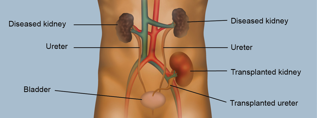 Illustration of how a kidney transplant works. The diseased kidneys along with a transplanted kidney and transplanted ureter are shown.